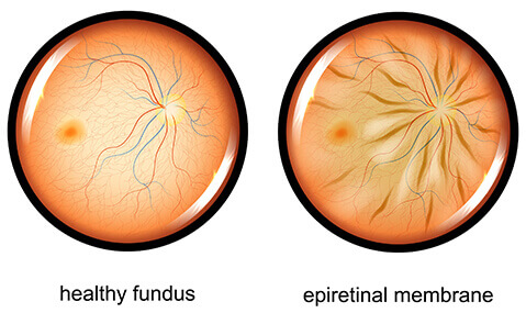 Normal Fundus vs Epiretinal Membrane