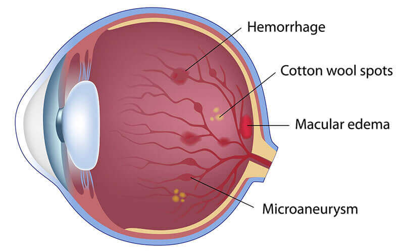 Non-Proliferative Diabetic Retinopathy