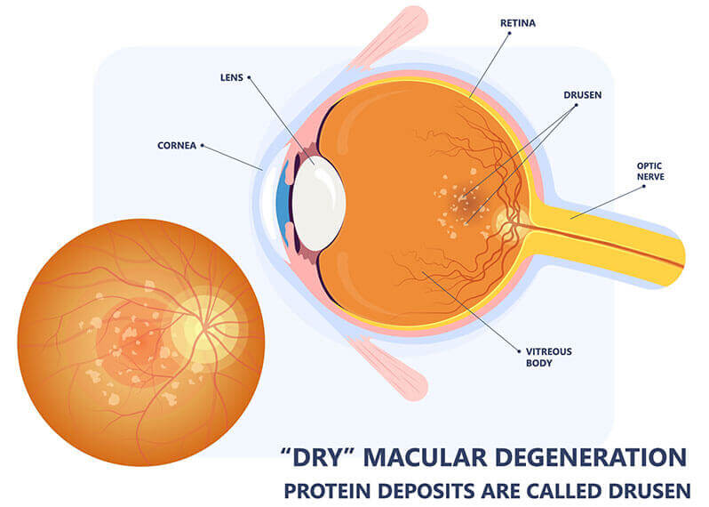 Dry Macular Degeneration Diagram