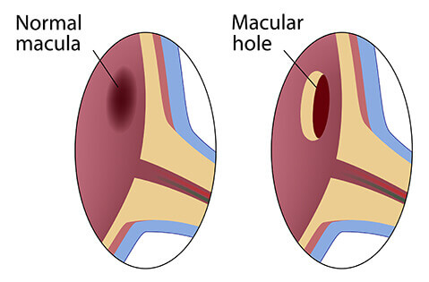 Diagram of Macular Hole
